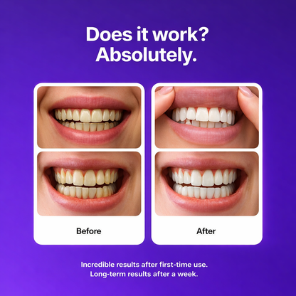 SmileIQ Whitening Strips